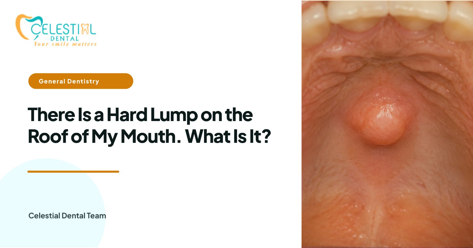 There Is a Hard Lump on the Roof of My Mouth. What Is It?