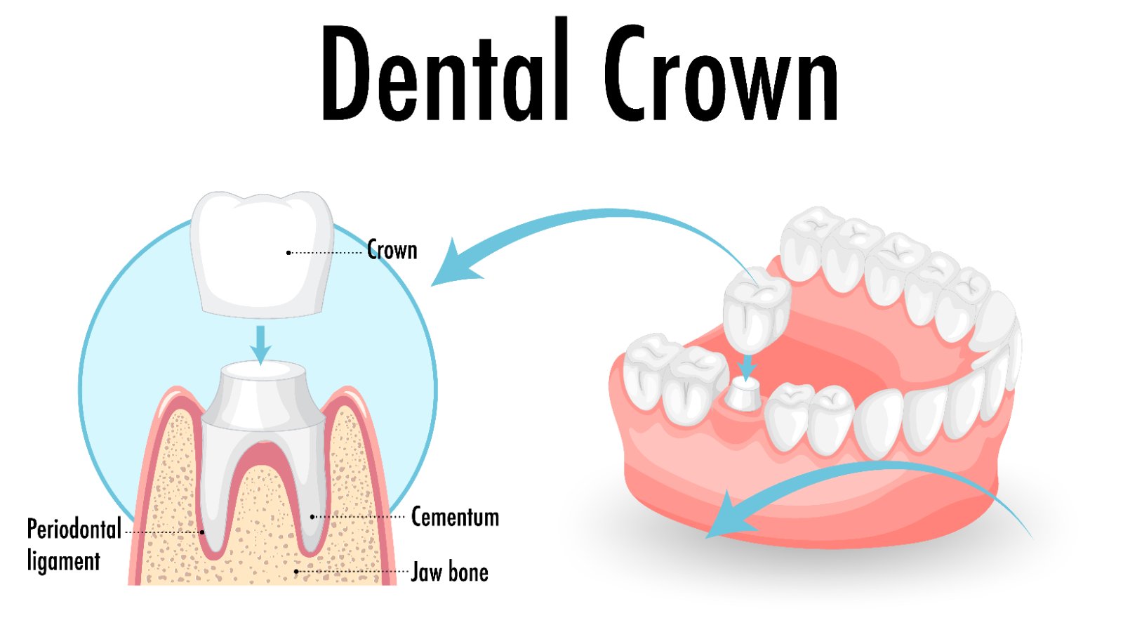 Do I Need a Dental Crown? Signs, Types and How Long They Last