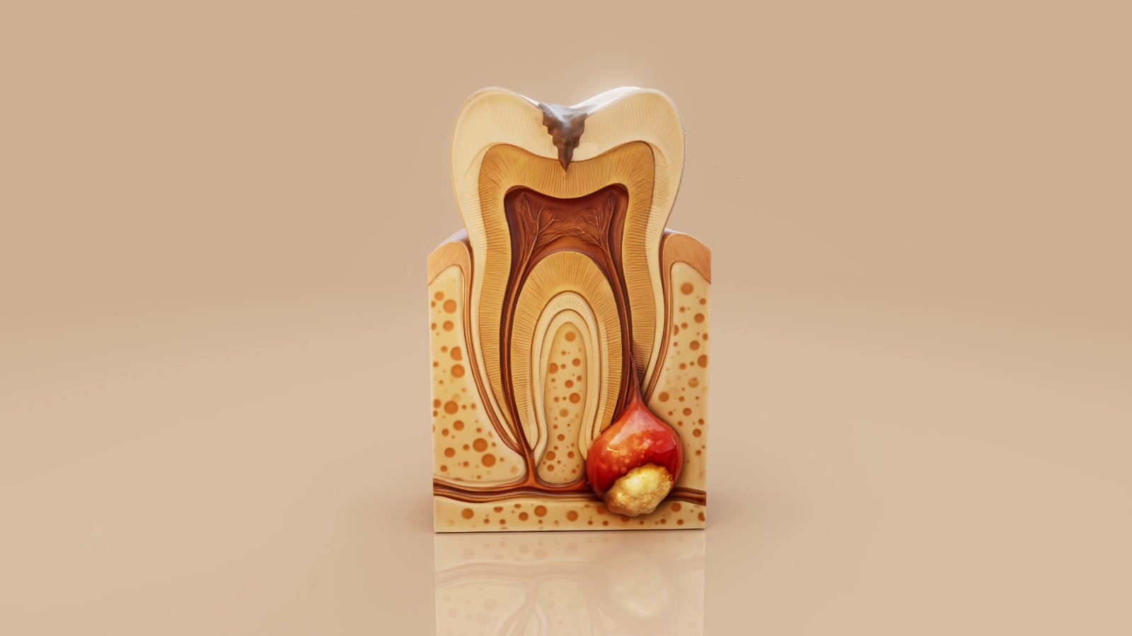 Dental Abscess: Swollen Gum or Face, and What to Do