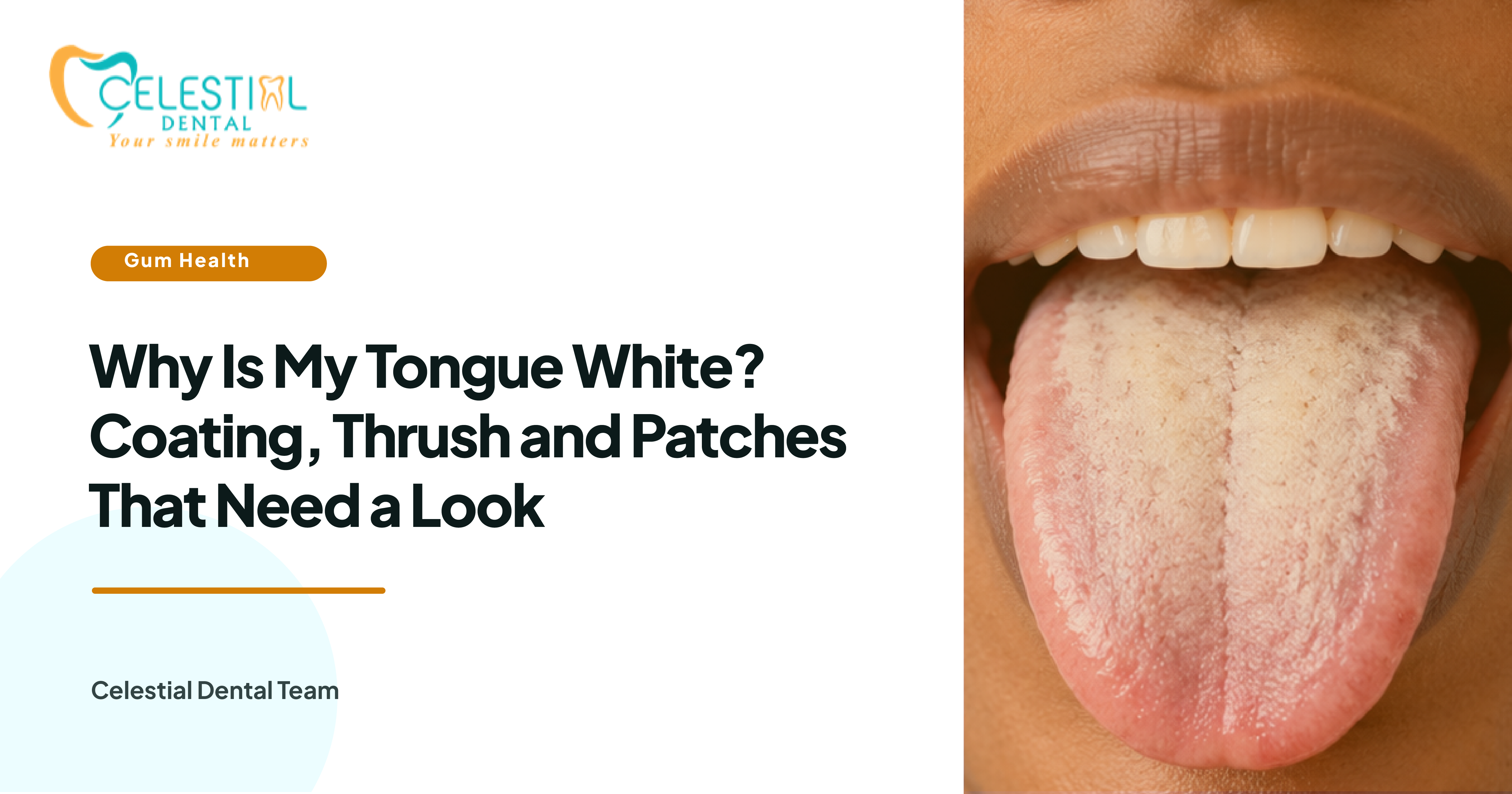 Why Is My Tongue White? Coating, Thrush and Patches That Need a Look