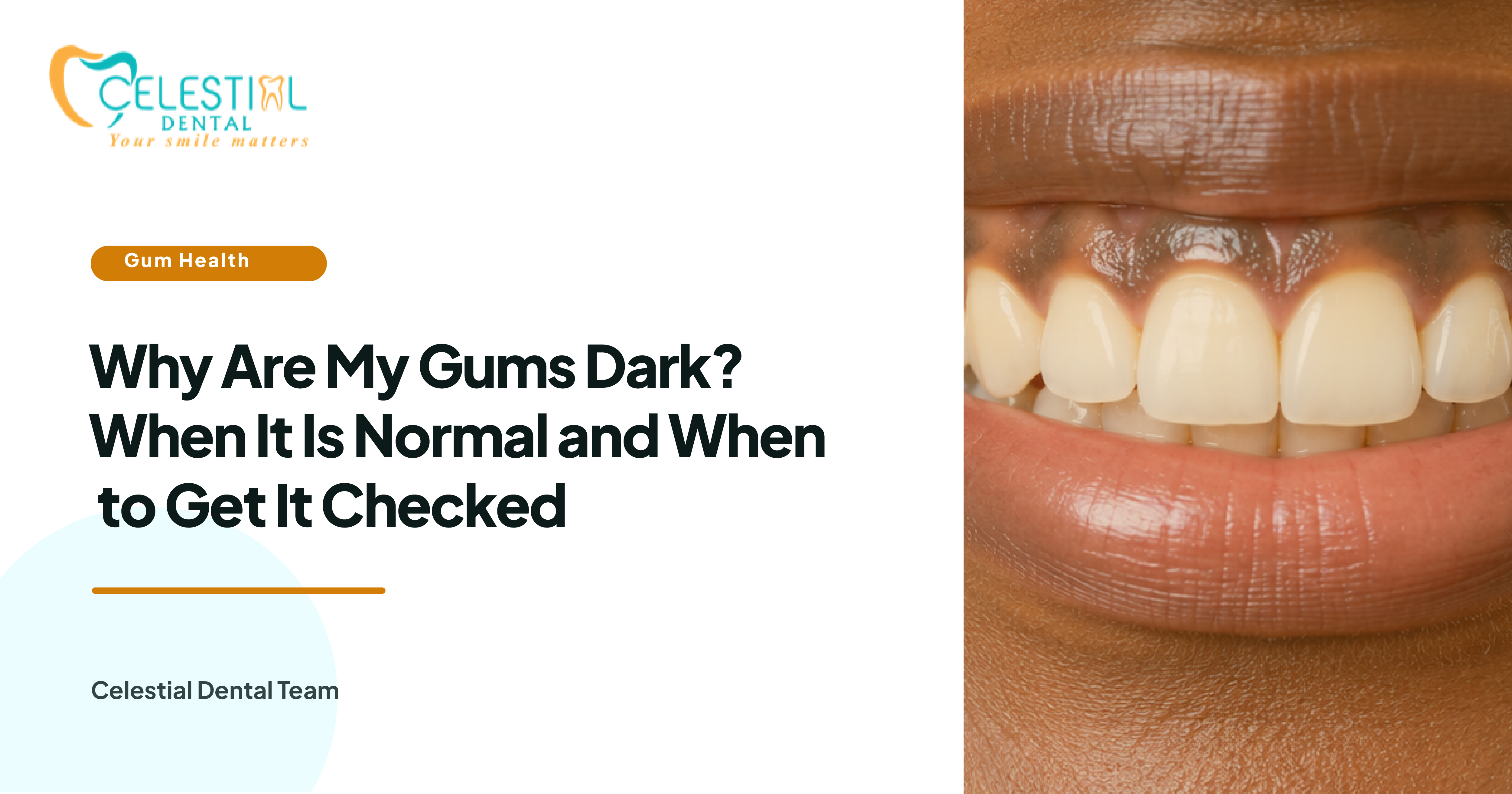 Why Are My Gums Dark? When It Is Normal and When to Get It Checked