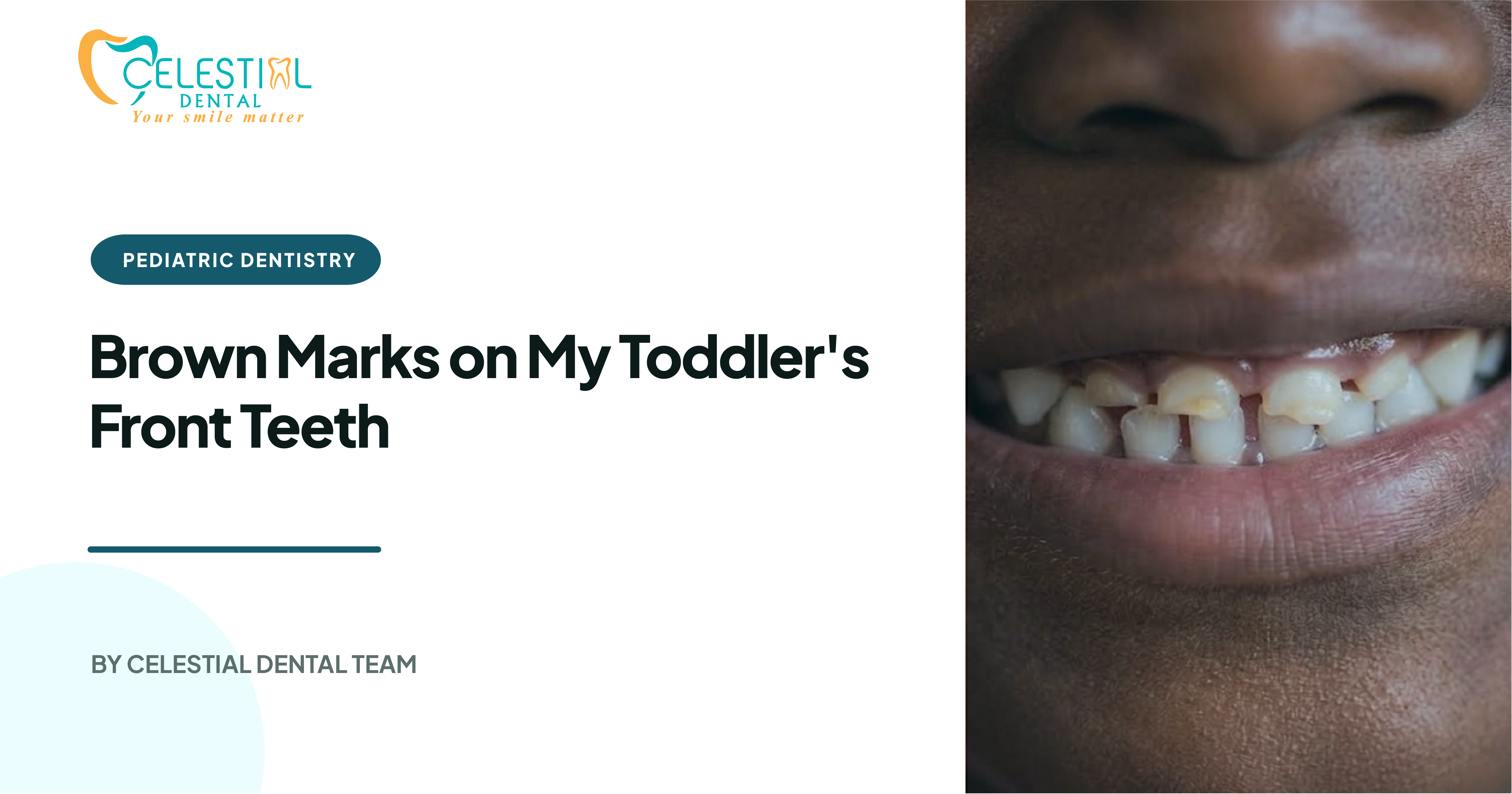 Brown Marks on My Toddler's Front Teeth