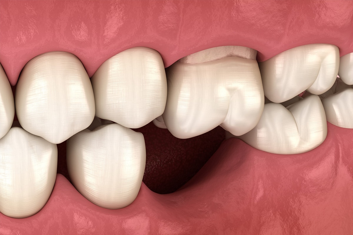 My Adult Tooth Feels Loose: Can It Be Saved?