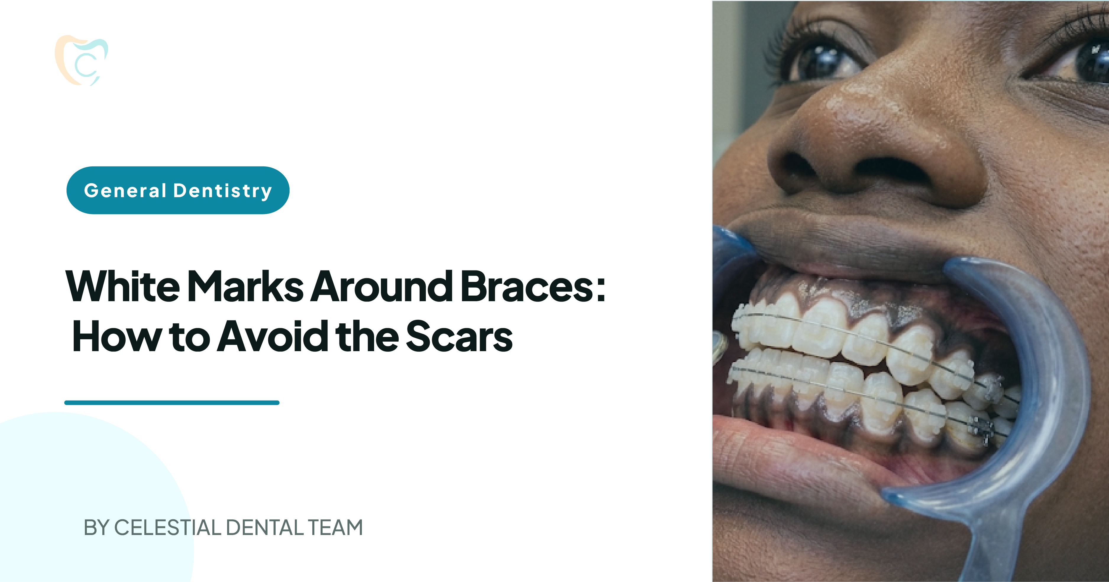White Marks Around Braces: How to Avoid the Scars